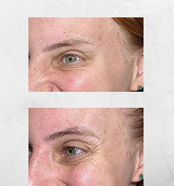 Resultado harmonização facial