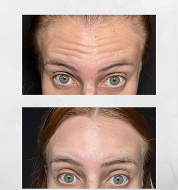 Resultado harmonização facial