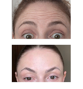 Resultado harmonização facial
