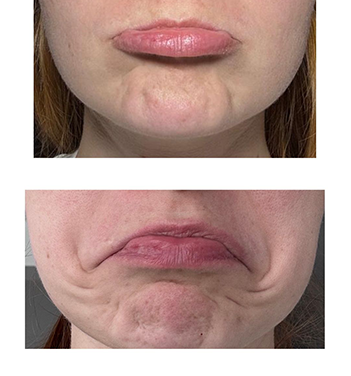 Resultado harmonização facial
